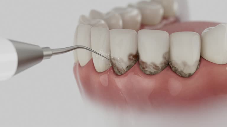 Reliable Dental Implants contractor in Aurora, MO by Smile Center Dentistry